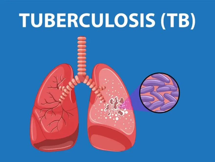 Group advocates holistic resource mobilization to face TB control